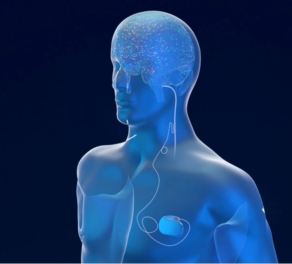 Kích thích thần kinh phế vị